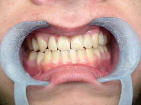 Case 3 — after treatment